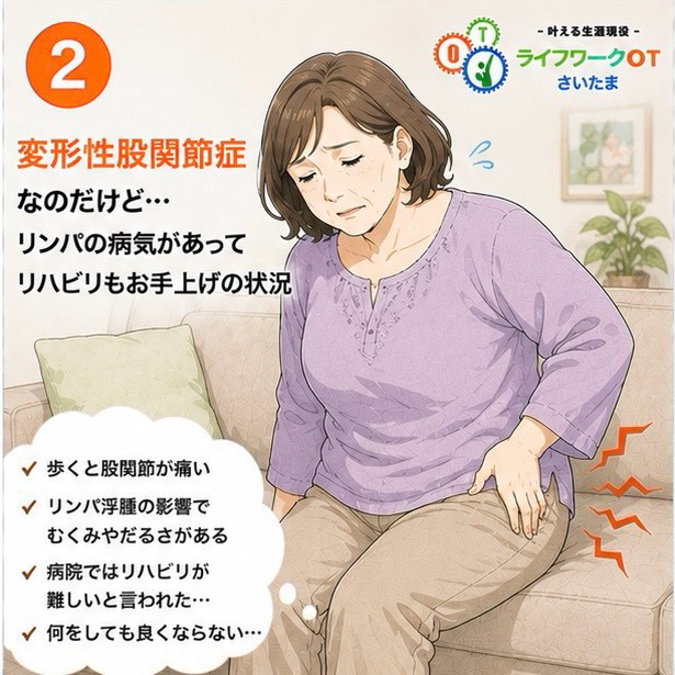 変形性股関節症とリンパ浮腫により歩行がつらい状態